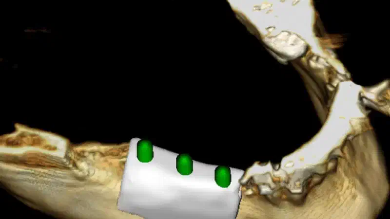 Ridge augmentation with maxgraft® bonebuilder