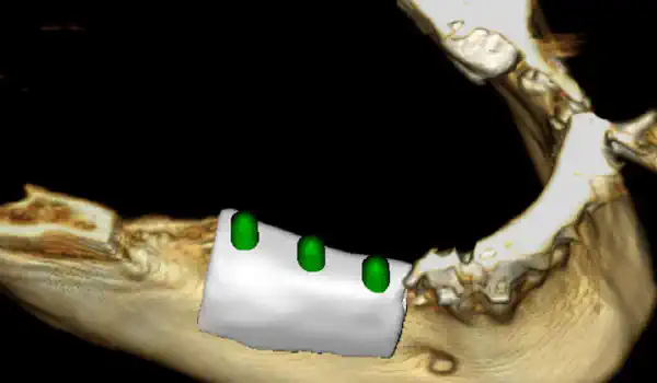 Image for case Ridge augmentation with maxgraft® bonebuilder