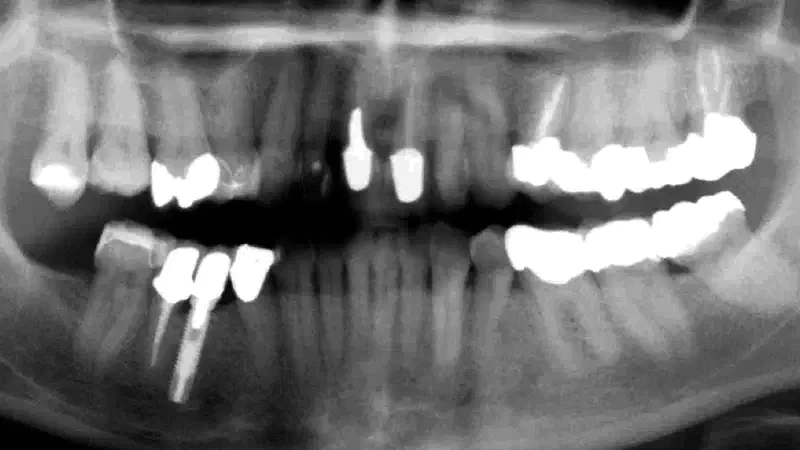 Ridge preservation with cerabone® & Jason® membrane