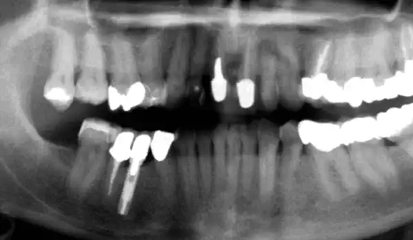 Image for case Ridge preservation with cerabone® & Jason® membrane
