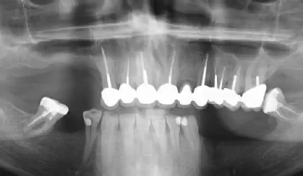 Image for case Lateral sinus lift one-stage with cerabone® & collagen fleece
