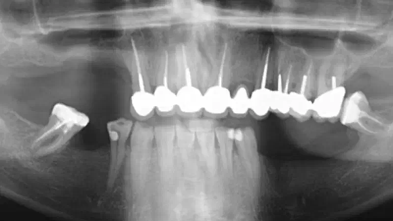 Lateral sinus lift one-stage with cerabone® & collagen fleece