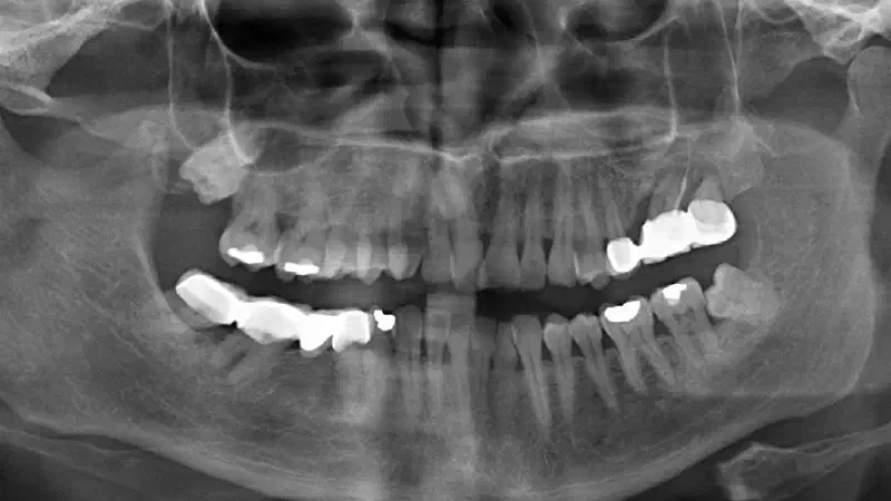Sinus lift two-stage with cerabone® and Jason® membrane