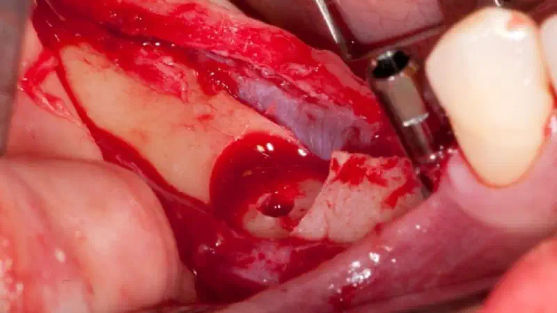 Vertical augmentation & sinus lift with maxgraft® bonering