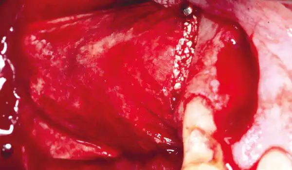 Image for case Alveolar ridge reconstruction in the posterior maxilla