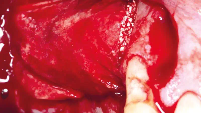 Alveolar ridge reconstruction in the posterior maxilla