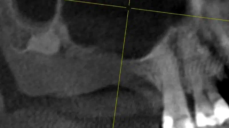 Lateral sinus lift one-stage with cerabone® & collprotect® membrane