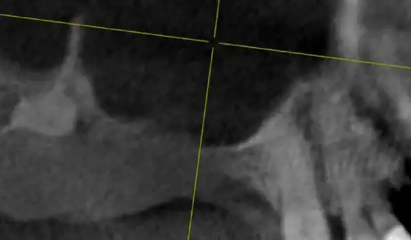 Image for case Lateral sinus lift one-stage with cerabone® & collprotect® membrane