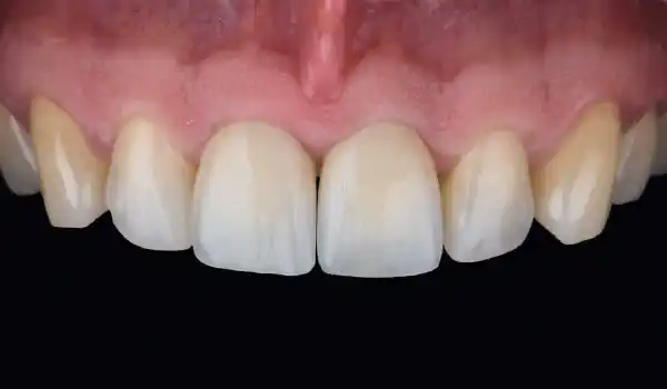 Image for case Sausage Technique with Jason® membrane