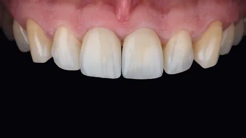Sausage Technique with Jason® membrane