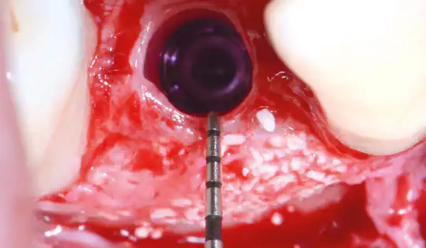 Image for case Entire papilla preservation technique (EPP) for the regenerative treatment of a severely compromised central incisor
