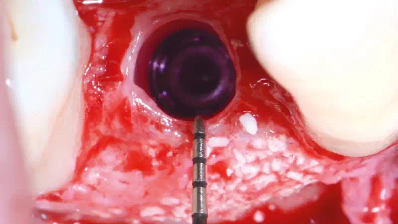 Entire papilla preservation technique (EPP) for the regenerative treatment of a severely compromised central incisor