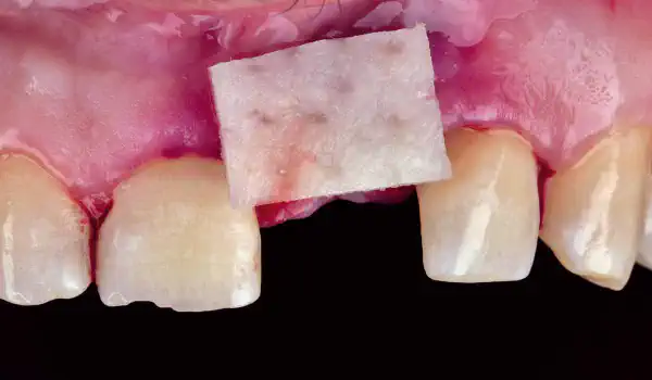 Image for case Peri-implant Soft Tissue Phenotype Modification Using Xenogeneic Collagen Matrix