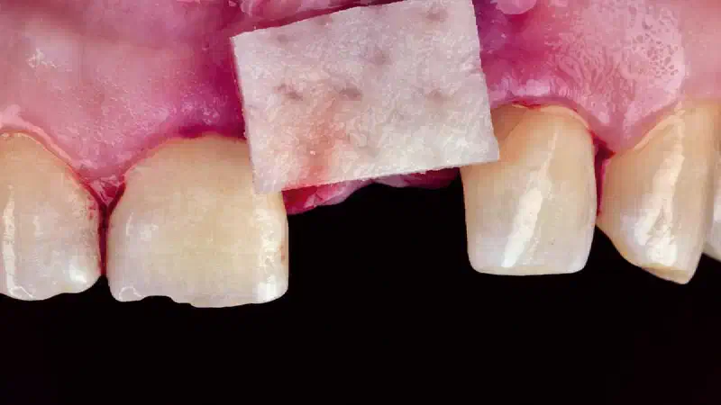Peri-implant Soft Tissue Phenotype Modification Using Xenogeneic Collagen Matrix