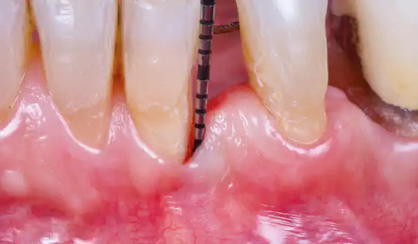 Image for case Regenerative management of an advanced endo-periodontal lesion using cerabone® +HyA and Jason® membrane