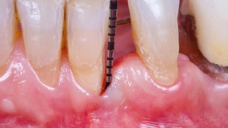 Regenerative management of an advanced endo-periodontal lesion using cerabone® +HyA and Jason® membrane