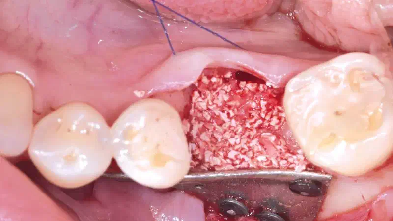 Management of Periimplantitis and Implant Replacement with Guided Bone Regeneration with NOVAMag® membrane and mucoderm®