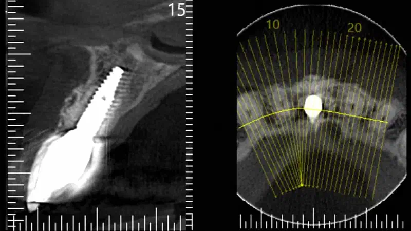 Rehabilitation with cerabone® and Jason® membrane after implant failure