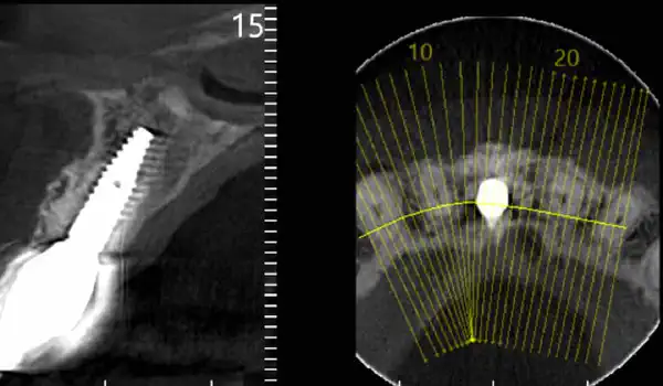 Image for case Rehabilitation with cerabone® and Jason® membrane after implant failure