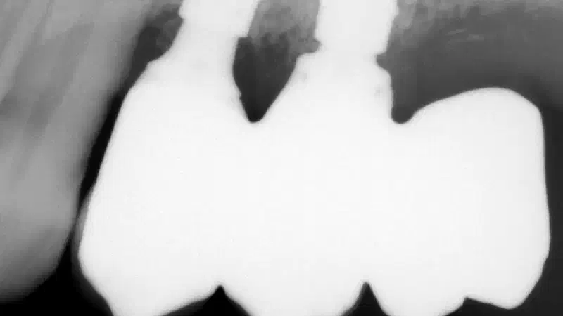 Management of buccal deficiency with NOVAMag® SHIELD for enhanced implant stability
