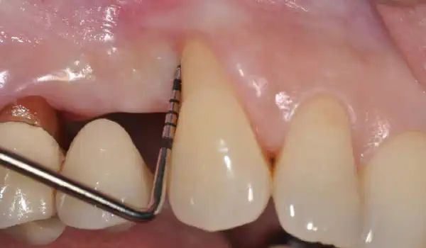 Image for case Regeneration of an intrabony defect using collprotect® membrane & cerabone®