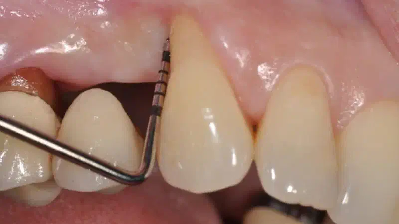 Regeneration of an intrabony defect using collprotect® membrane & cerabone®