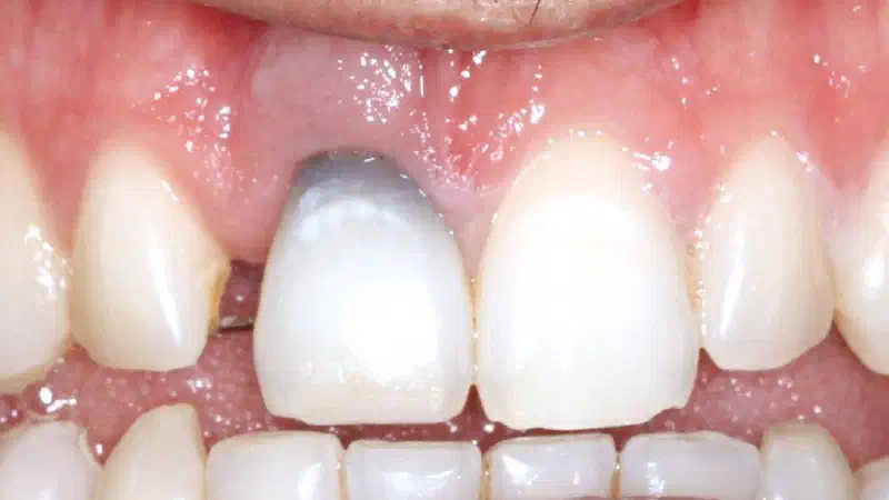 Type II socket defect grafted and repaired flapless way using Jason® membrane and maxgraft®