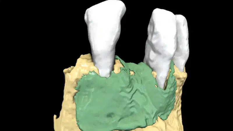 Horizontal GBR with a tunnel approach using resorbable NOVAMag® membrane – radiographic evaluation of hard tissue gain