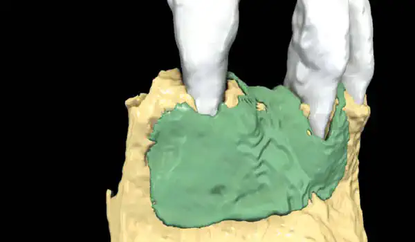 Image for case Horizontal GBR with a tunnel approach using resorbable NOVAMag® membrane – radiographic evaluation of hard tissue gain