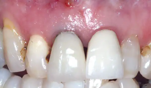 Image for case Immediate implants teeth number 12 and 11 dual zone grafting using maxgraft® granules