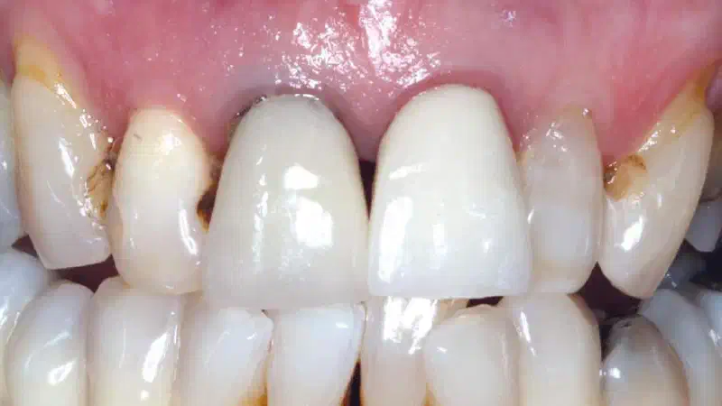 Immediate implants teeth number 12 and 11 dual zone grafting using maxgraft® granules
