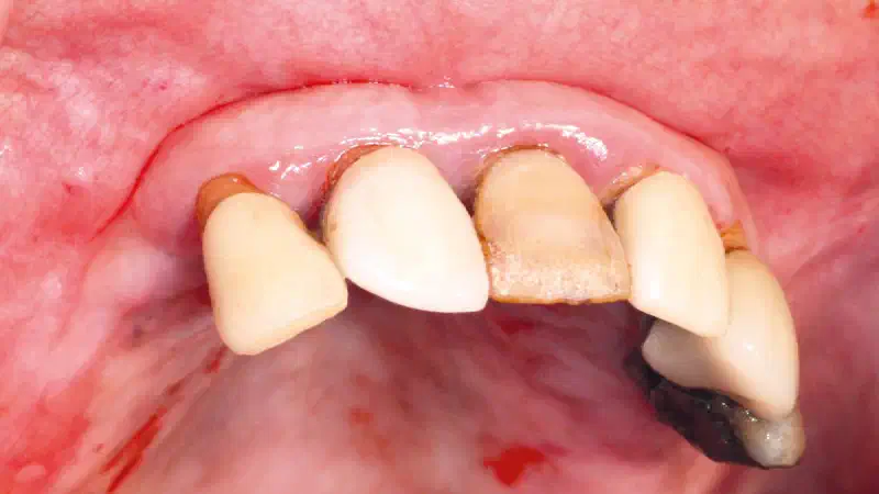 Ridge reconstruction after severe buccal bone loss – immediate implant placement with NOVAMag® membrane