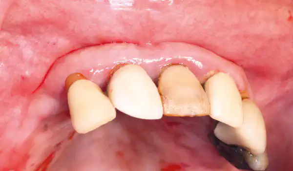 Image for case Ridge reconstruction after severe buccal bone loss – immediate implant placement with NOVAMag® membrane
