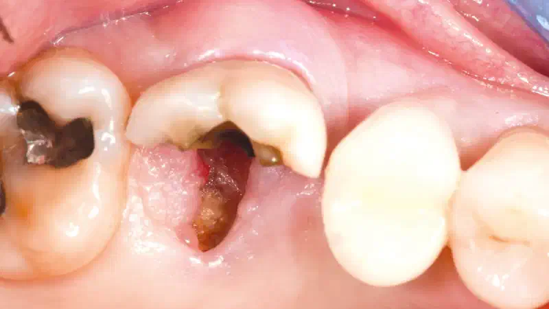 Reconstruction of the alveolar buccal wall in a compromised extraction socket using NOVAMag® SHIELD and cerabone®