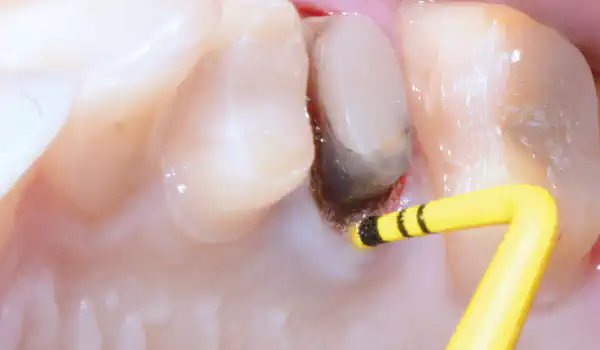 Image for case Full bone regeneration in extraction socket augmented with maxgraft® and Jason® membrane