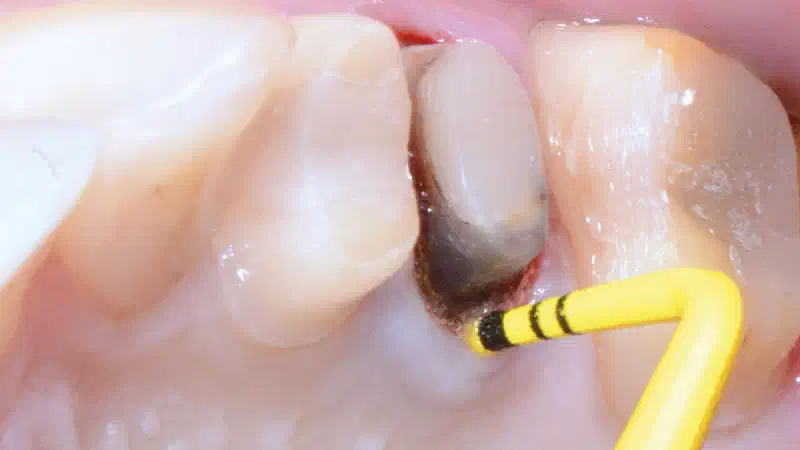 Full bone regeneration in extraction socket augmented with maxgraft® and Jason® membrane