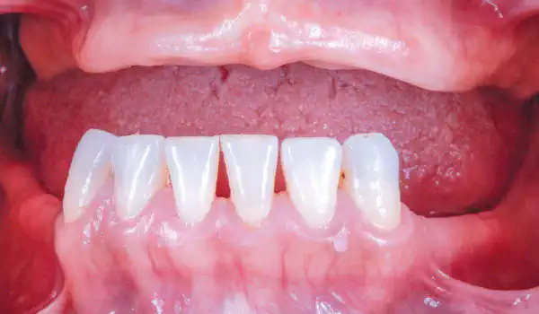 Image for case Full arch GBR using cerabone®, maxgraft® and Jason® membrane with simultaneous implantation of 6 Straumann® implants