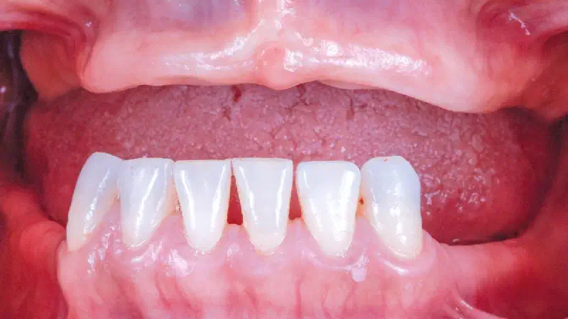 Full arch GBR using cerabone®, maxgraft® and Jason® membrane with simultaneous implantation of 6 Straumann® implants