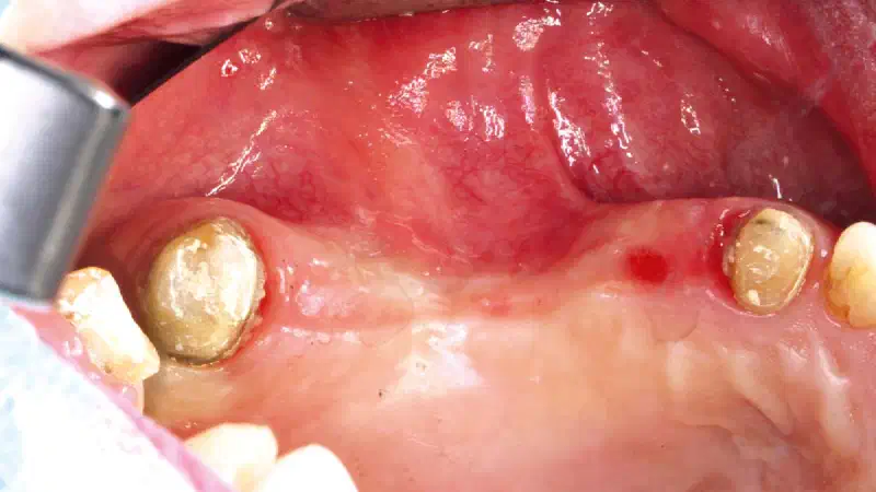Ridge augmentation with maxgraft® bonebuilder and vestibuloplasty with mucoderm® in the maxilla