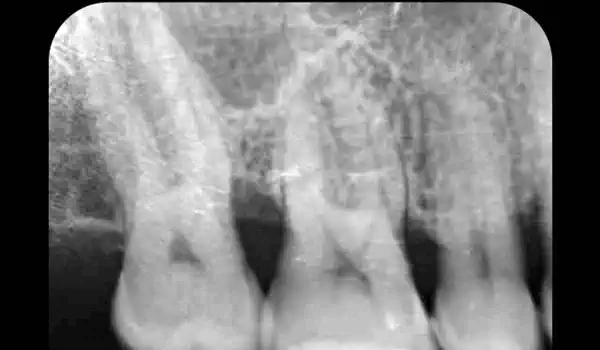 Image for case Intrabony defect in conjunction with Emdogain®