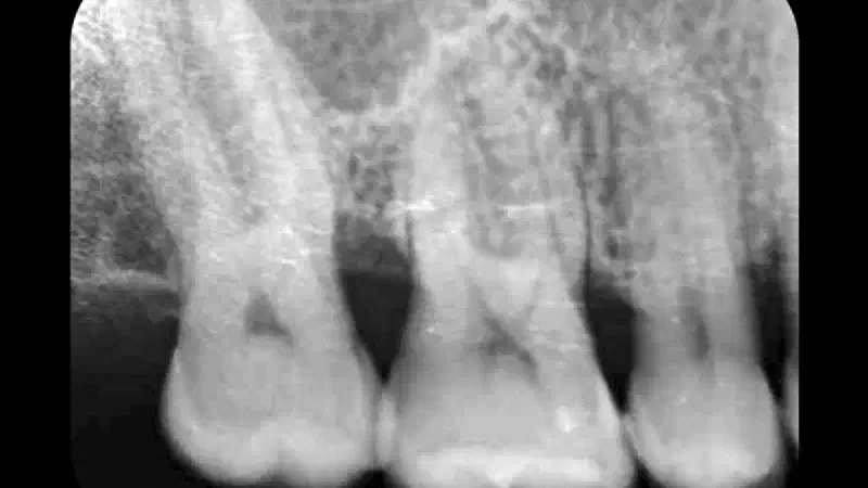 Intrabony defect in conjunction with Emdogain®