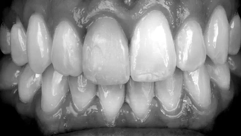 Immediate implant with cerabone® +HyA in the aesthetic zone