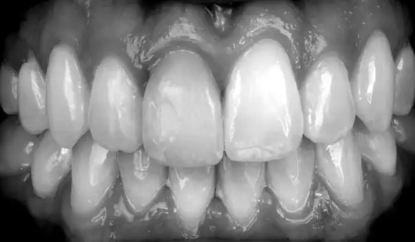 Image for case Immediate implant with cerabone® +HyA in the aesthetic zone