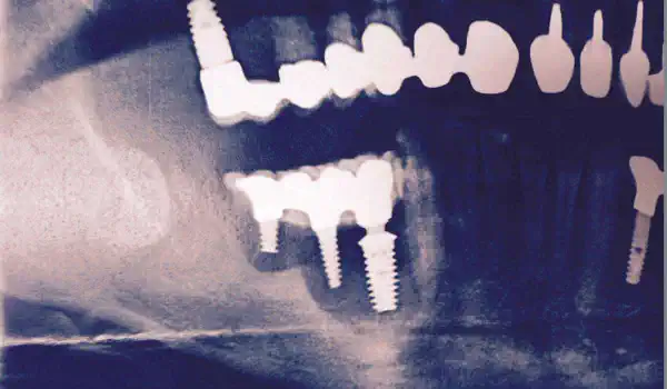 Image for case Augmentation in the mandible with maxgraft® bonebuilder