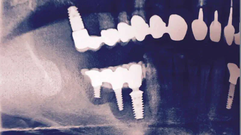Augmentation in the mandible with maxgraft® bonebuilder