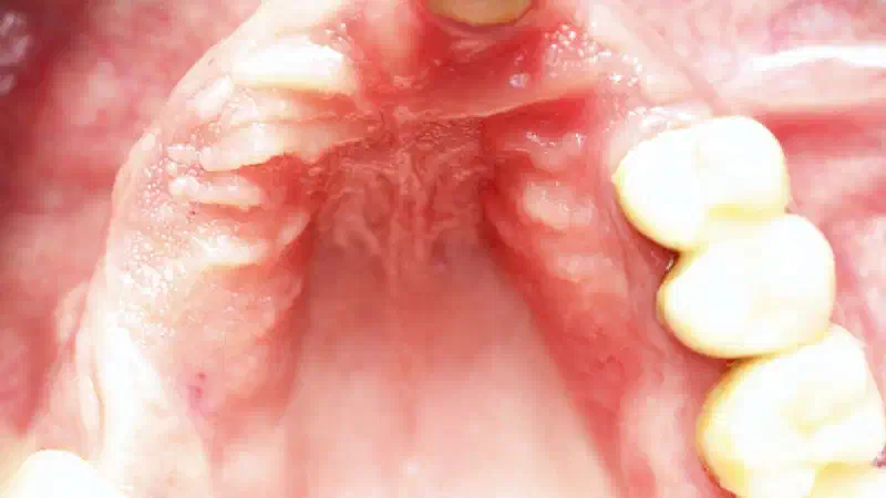 Block augmentation with maxgraft® in the maxilla