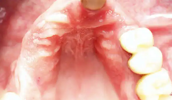 Image for case Block augmentation with maxgraft® in the maxilla