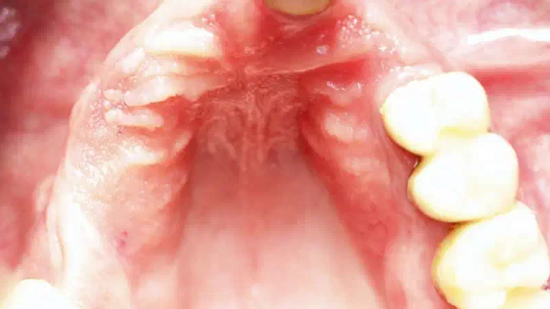 Augmentation of an atrophic maxilla with maxgraft® bonebuilder