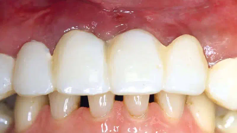 Restoration of all four incisors with maxgraft® bonebuilder