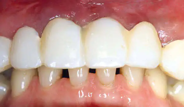 Image for case Restoration of all four incisors with maxgraft® bonebuilder